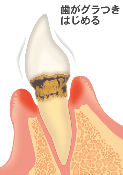 歯周病中度