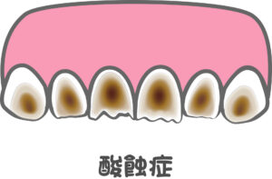 酸蝕歯